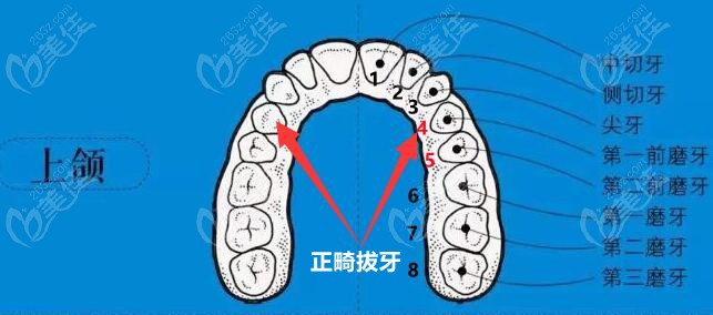 正畸一般拔哪四颗牙