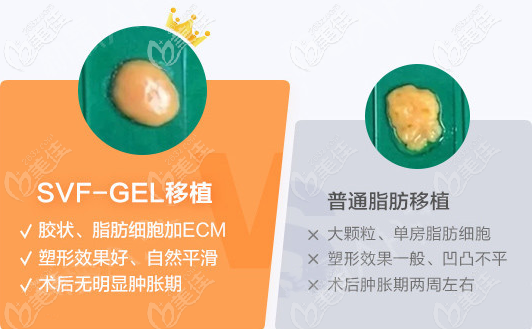 羅海軍做svf-gel脂肪膠全臉填充有啥技術(shù)特色