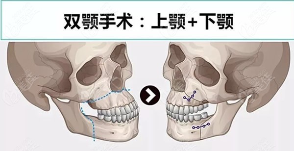 雙鄂手術(shù)中國做得好還是韓國好