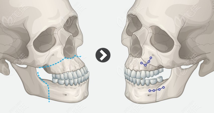 图解正颌手术怎么做