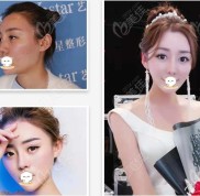 合肥做面部脂肪填充好的醫(yī)院名單