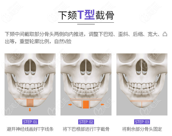 颏成型哪里做比较好