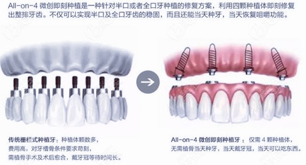 牙槽骨水平吸收可以植骨吗