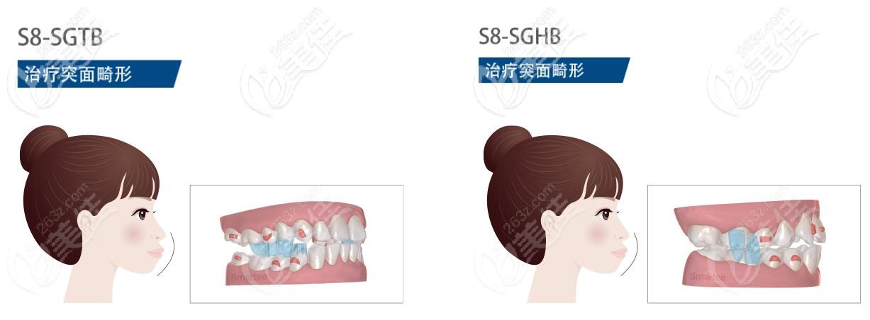 磕到了正雅s8隱形牙套的價格后