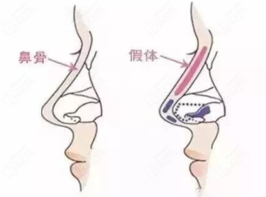 長沙凱萊整形劉凱做鼻子怎么樣