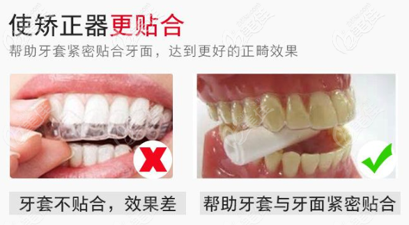 戴隐适美这种隐形牙套不咬胶会有啥后果