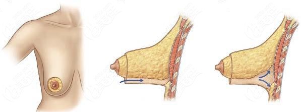 雙環(huán)切口的乳房提升手術(shù)圖解來看乳房雙環(huán)懸吊術(shù)是如何操作的