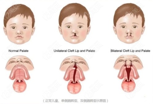 隱唇裂不修復(fù)鼻子會越來越塌嗎