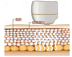 說(shuō)7d聚拉提和BTL面部射頻緊膚的區(qū)別前