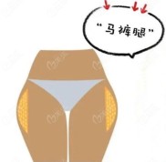 2024鄭州抽脂手術(shù)價(jià)格表
