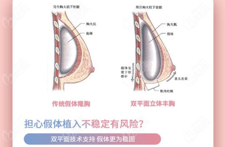 合肥维多利亚何贤清做维密丰胸技术挺好