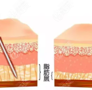 2024年濟南全身吸脂減肥手術(shù)的價格公示如下