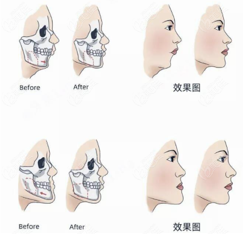 骨性嘴凸怎么矯正呢