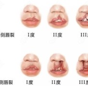 廣西南寧市哪里做唇裂好