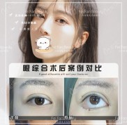六安哪家醫(yī)院做雙眼皮手術(shù)比較好價(jià)格還不貴呢