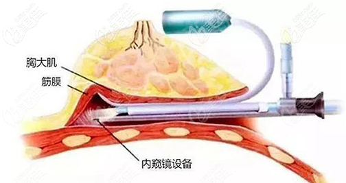 重慶時(shí)光那個(gè)IN-BRA動(dòng)感假體豐胸是個(gè)什么技術(shù)