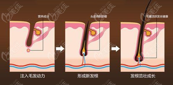 目前贵阳较先进的植发技术有哪些