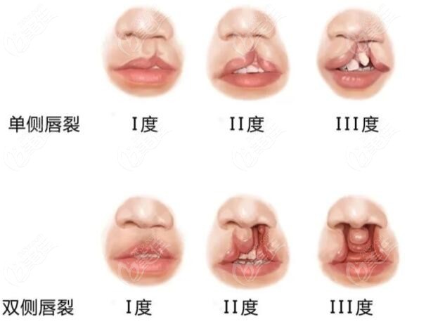 全国做唇腭裂二期修复好的医院和手术费用更新