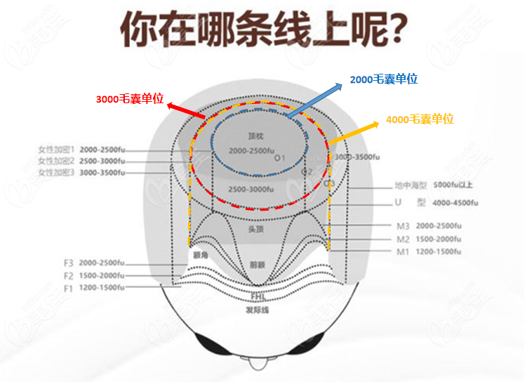 2000/3000/4000毛囊單位能植多大面積