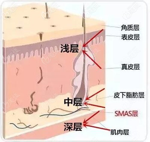 自體脂肪填充法令紋一年后反而加深了