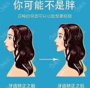 湘潭口腔醫(yī)院矯正牙齒要多少錢