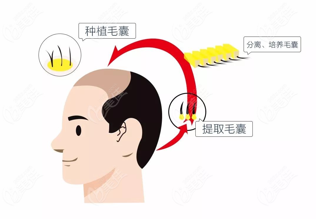 海南疤痕植发一般多少钱