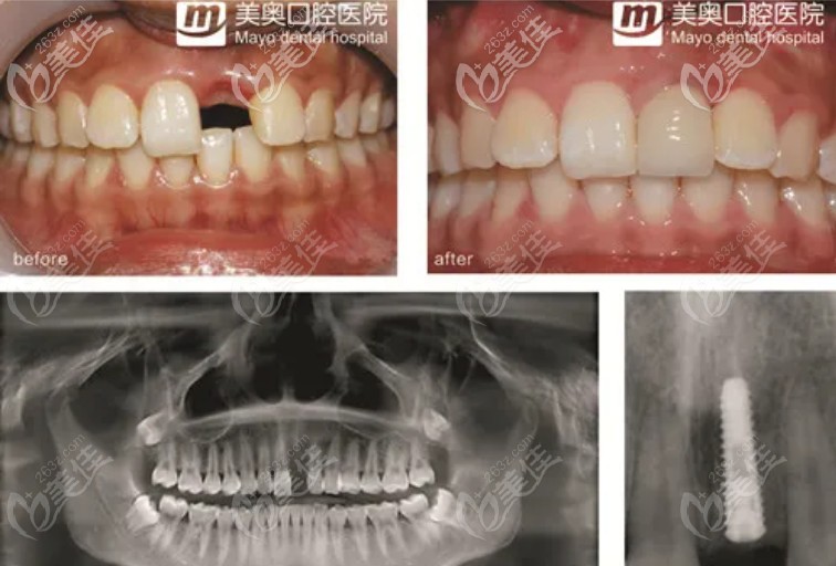 重庆美奥口腔做种植牙靠谱吗