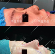 重慶哪個(gè)醫(yī)生隆鼻好