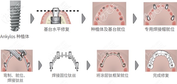 南京博韻口腔的速齒種植技術(shù)使半全口種植牙修復(fù)加快節(jié)奏