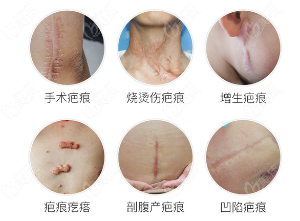 郑州去疤痕正规的医院排名中治疗疤痕疙瘩哪家好