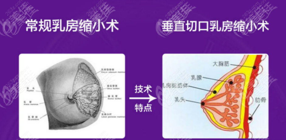 生完孩子多久可以做缩胸手术