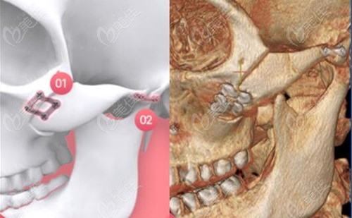 3d打印人工骨填充面部會有異物感嗎