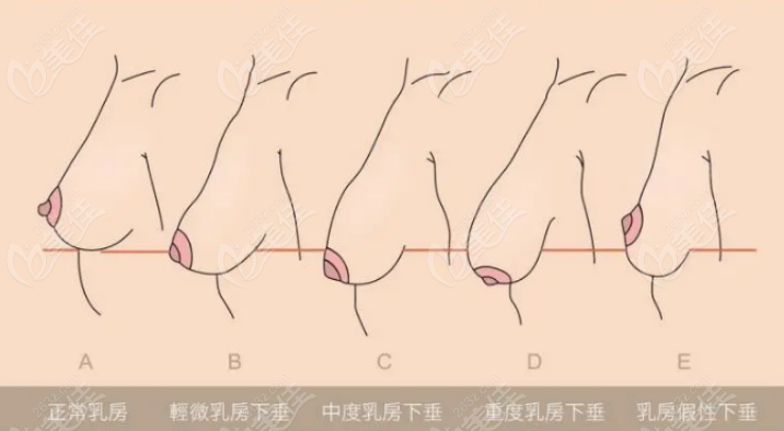 胸挺大的但下垂