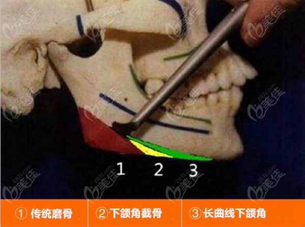 武汉做下颌角磨骨的人气医生排名里有下颌角削骨的对比图