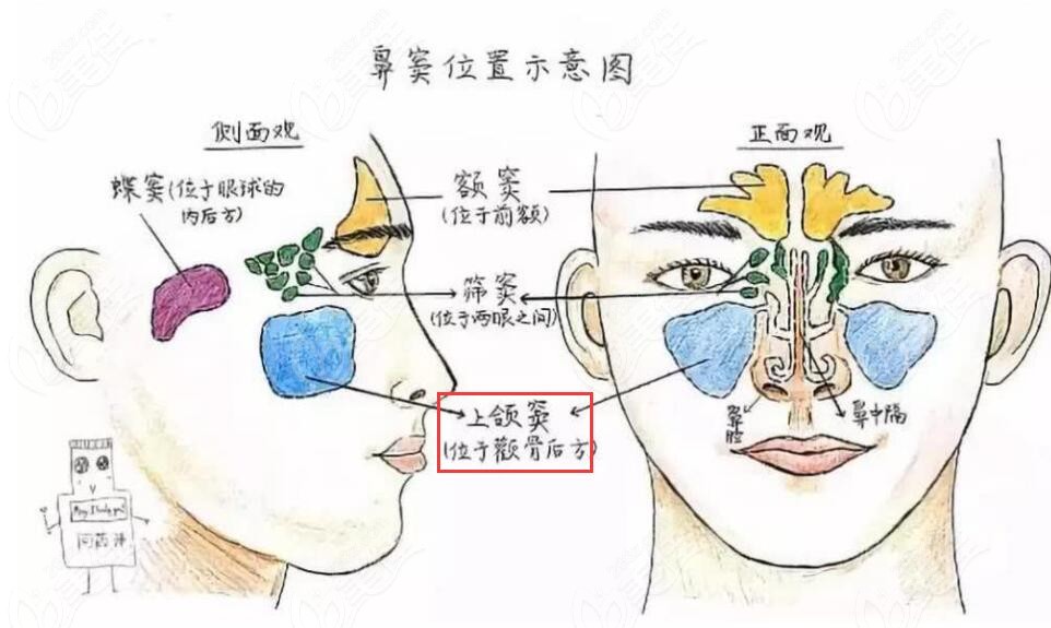 种植牙为什么要做上颌窦提升