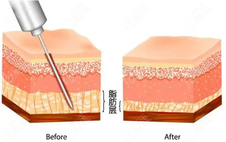 2022泰國抽脂價格公布