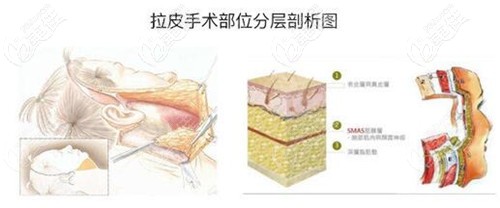 深圳艺星面部除皱方法有埋线提升和小切口拉皮