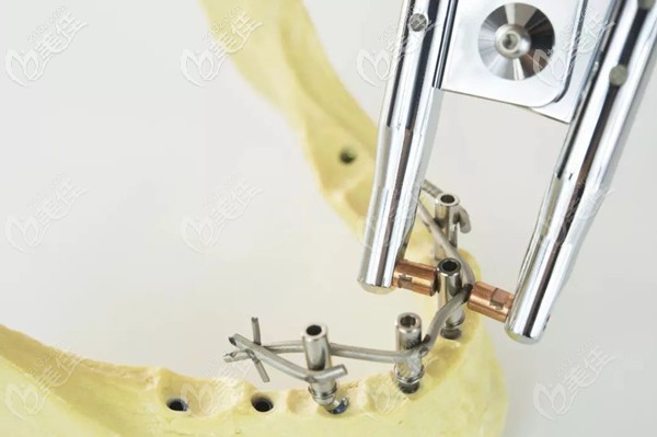 南京博韵口腔的速齿种植技术使半全口种植牙修复加快节奏