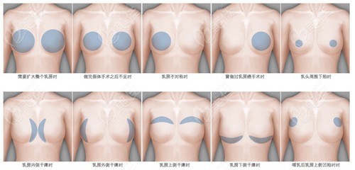 南昌佳美做5G维密隆胸好到人人都竖大拇指夸