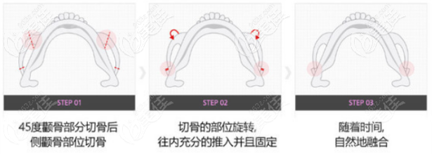 想知道颧弓手术大约多少钱吗