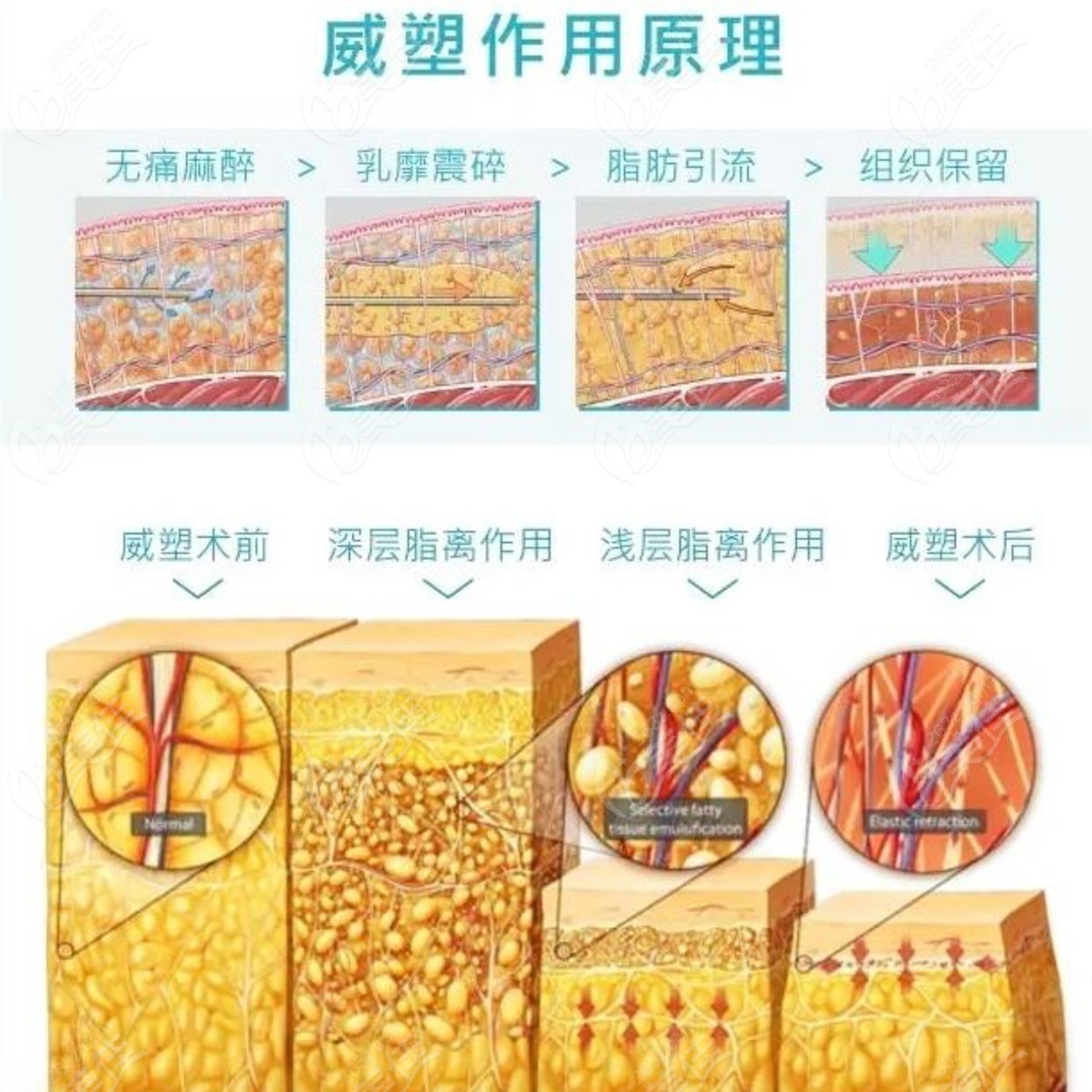 黃金微雕吸脂和威塑二代吸脂哪個(gè)瘦腰腹更好