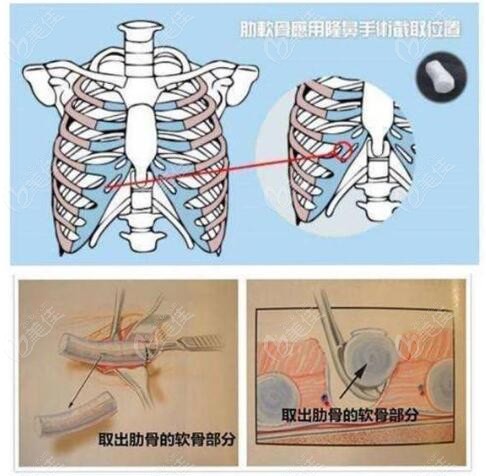 南京曹海峰做鼻失败修复怎么样