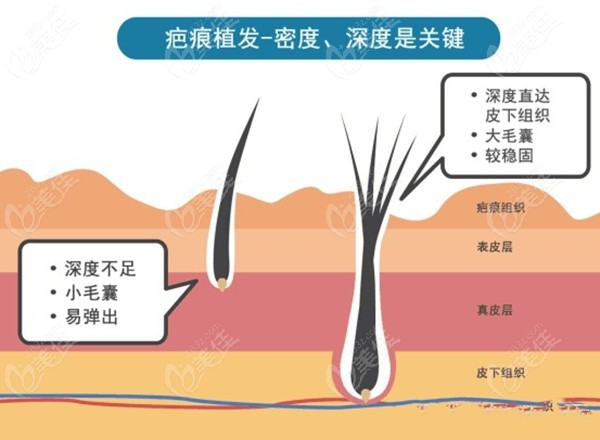 秦皇岛植发医院排名前三里有两家竟可以免费检测毛囊