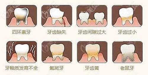 四環(huán)素牙貼面所用的琥珀瓷、藍(lán)瓷、水晶瓷和玻璃瓷在價(jià)格上的區(qū)別很大