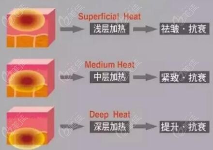 同是單極射頻的既塑3d和熱瑪吉的區(qū)別