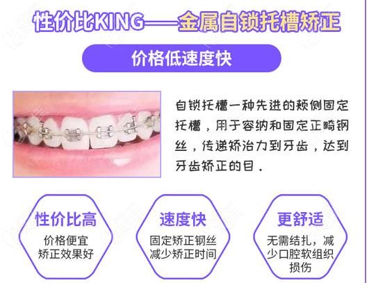 哪種牙齒矯正器效果比較好