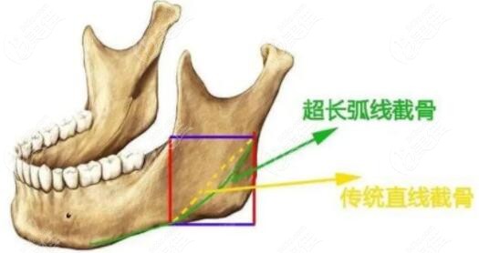 做完下頜角手術(shù)后疤痕多久可以軟化