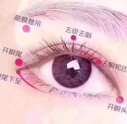 在武漢天申做過(guò)雙眼皮能說(shuō)說(shuō)朱天申院長(zhǎng)割雙眼怎么樣