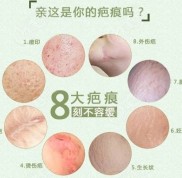 貴陽利美康梁安裕醫(yī)生疤痕治療好