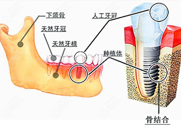 分享贵阳柏德口腔种植牙价格表及种植牙技术怎么样